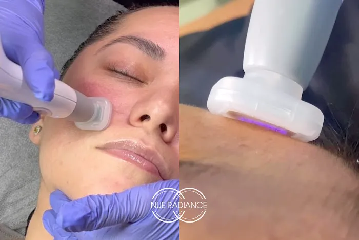 Nue Radiance - Jet Plasma and Fibroblast Treatments & Training Picture 5
