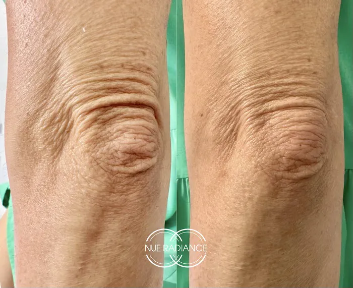 Nue Radiance - Jet Plasma and Fibroblast Treatments & Training Picture 6