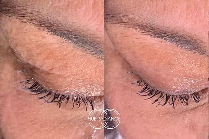 Nue Radiance - Jet Plasma and Fibroblast Treatments & Training Picture 4