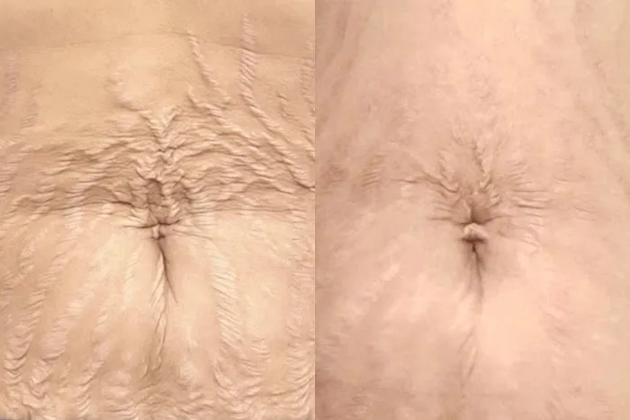 Nue Radiance - Jet Plasma and Fibroblast Treatments & Training Picture 9