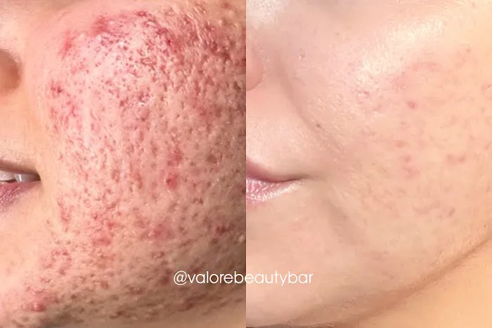 Nue Radiance - Jet Plasma and Fibroblast Treatments & Training Picture 8