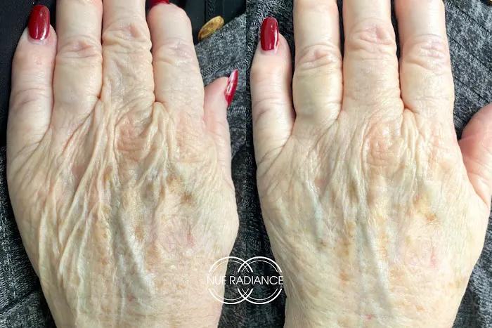 Nue Radiance - Jet Plasma and Fibroblast Treatments & Training Picture 7