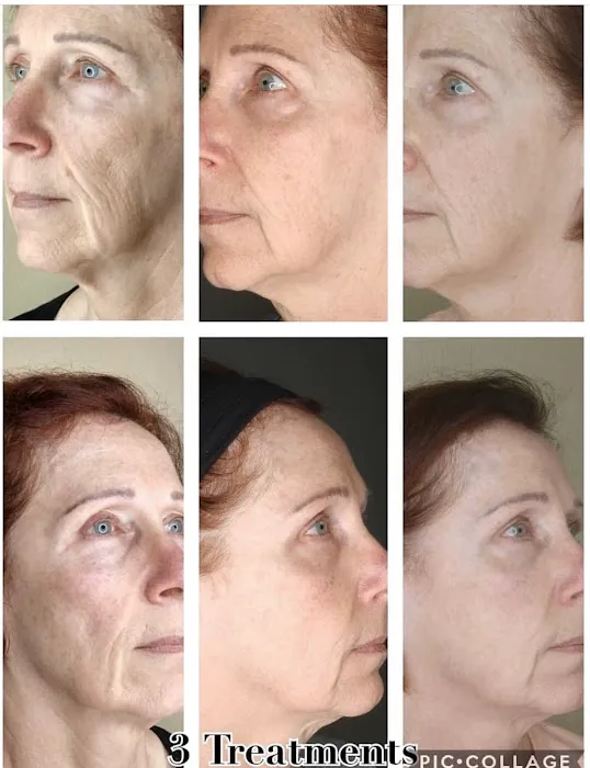 Downey Glo2Facial & Hydrafacial MD Skin Studio. Picture 8