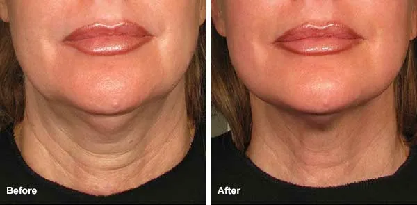 Skin Tightening Solution Picture 10