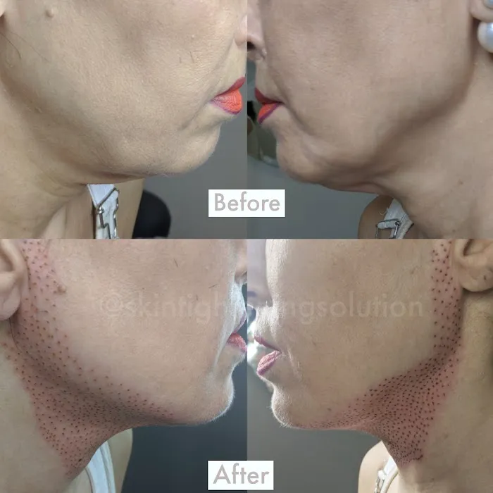 Skin Tightening Solution Picture 8
