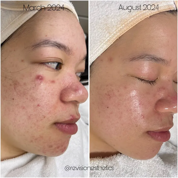 Revision Esthetics Picture 6