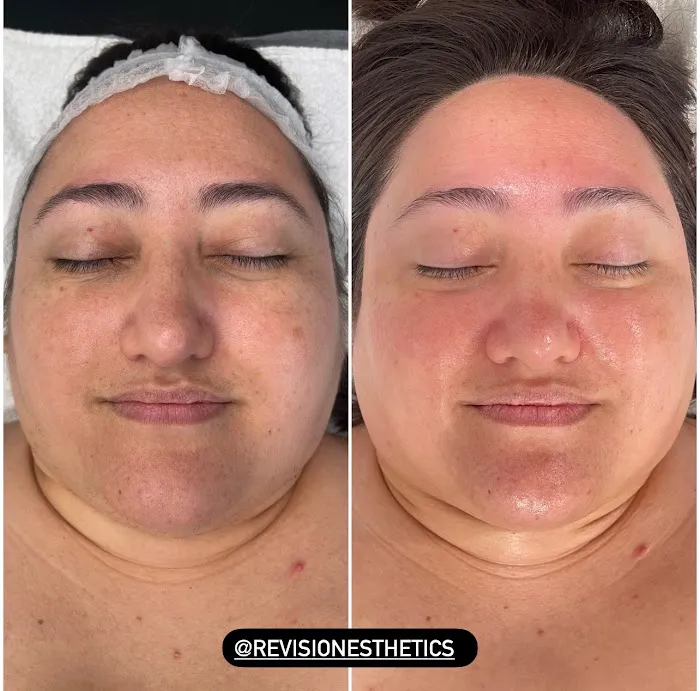 Revision Esthetics Picture 10