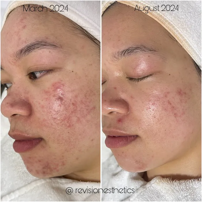 Revision Esthetics Picture 9