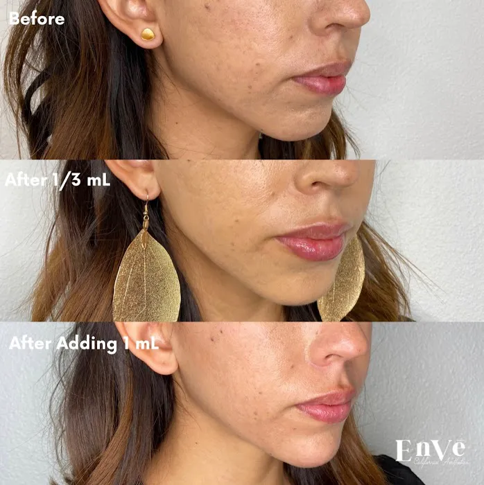 Enve California Aesthetics Picture 8