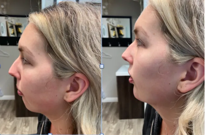 Botox It Andrea Dunkelman MD, FACS Picture 1