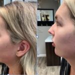 Botox It Andrea Dunkelman MD, FACS