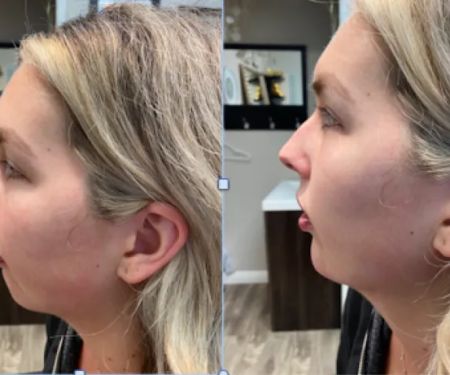 Botox It Andrea Dunkelman MD, FACS