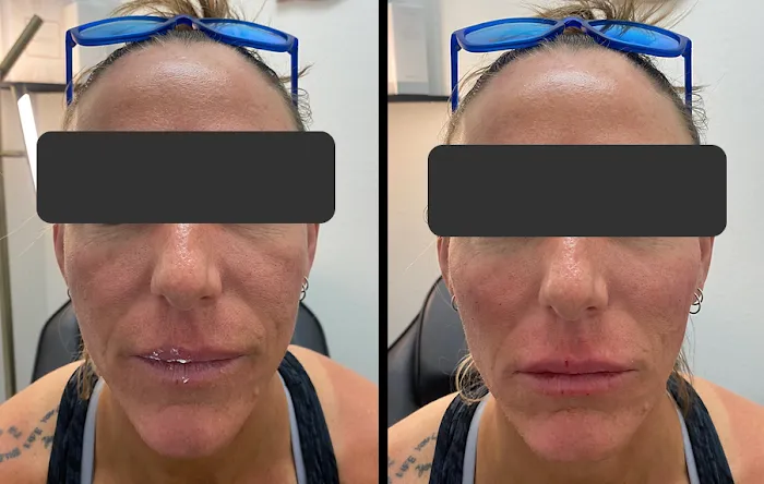 Botox It Andrea Dunkelman MD, FACS Picture 2