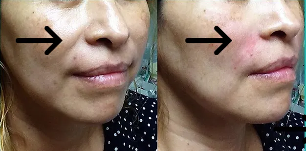 Botox It Andrea Dunkelman MD, FACS Picture 4