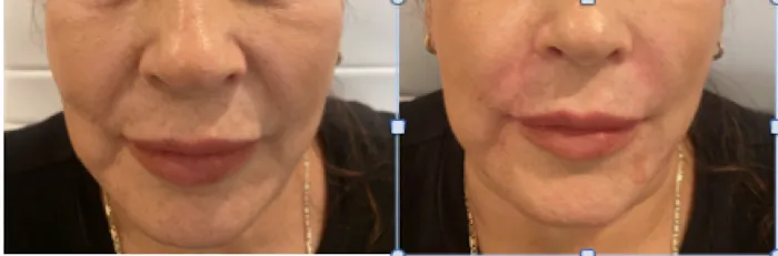 Botox It Andrea Dunkelman MD, FACS Picture 6