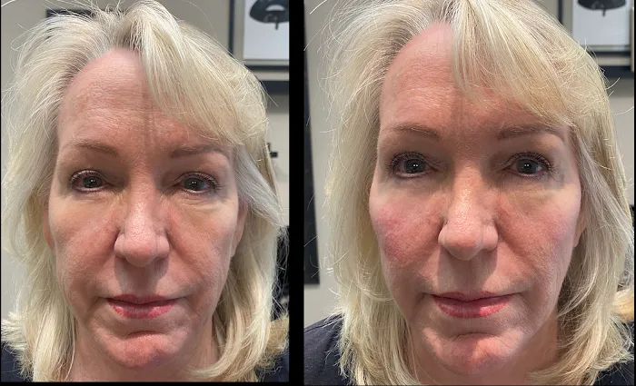 Botox It Andrea Dunkelman MD, FACS Picture 7