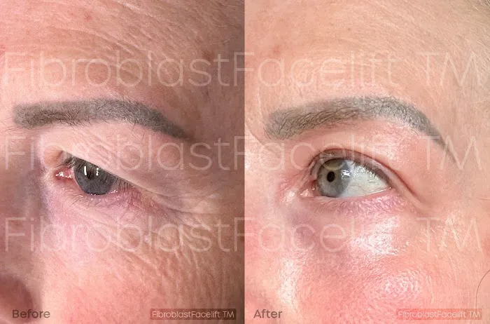 Fibroblast Facelift Picture 1