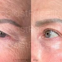 Fibroblast Facelift ico