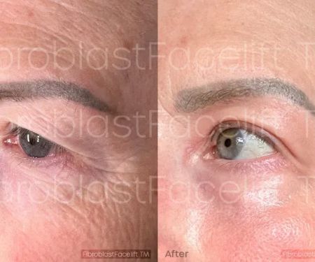 Fibroblast Facelift