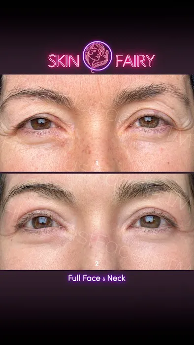 Fibroblast Facelift Picture 6