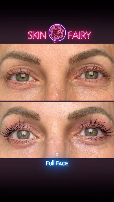 Fibroblast Facelift Picture 7