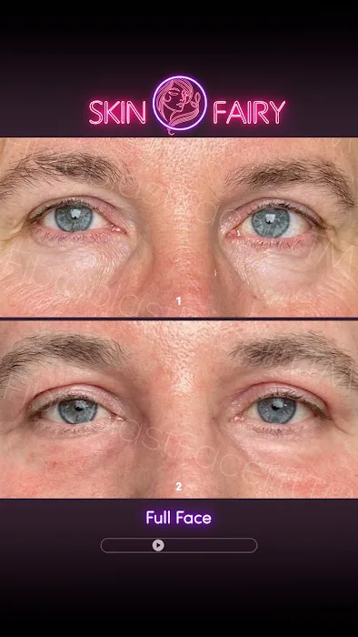 Fibroblast Facelift Picture 5