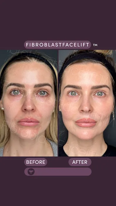 Fibroblast Facelift Picture 10
