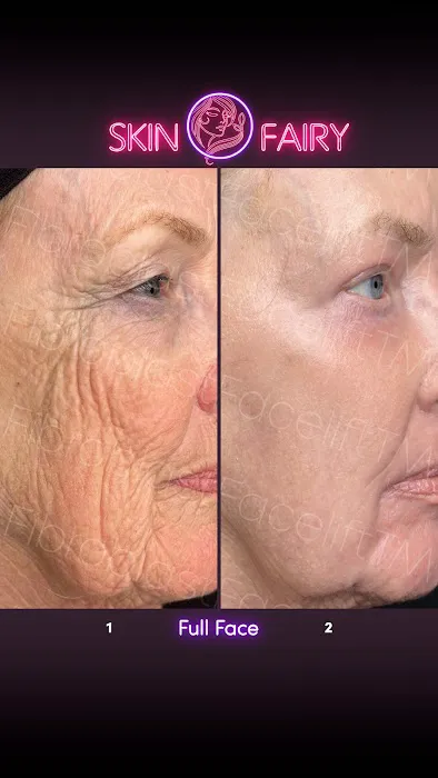Fibroblast Facelift Picture 8