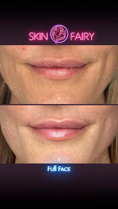 Fibroblast Facelift Picture 9