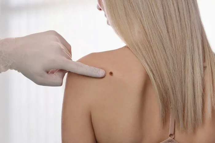 Mole Removal Los Angeles Picture 8