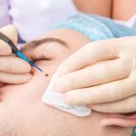 Mole Removal Los Angeles