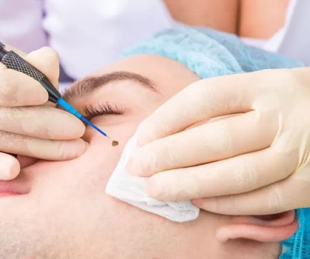 Mole Removal Los Angeles