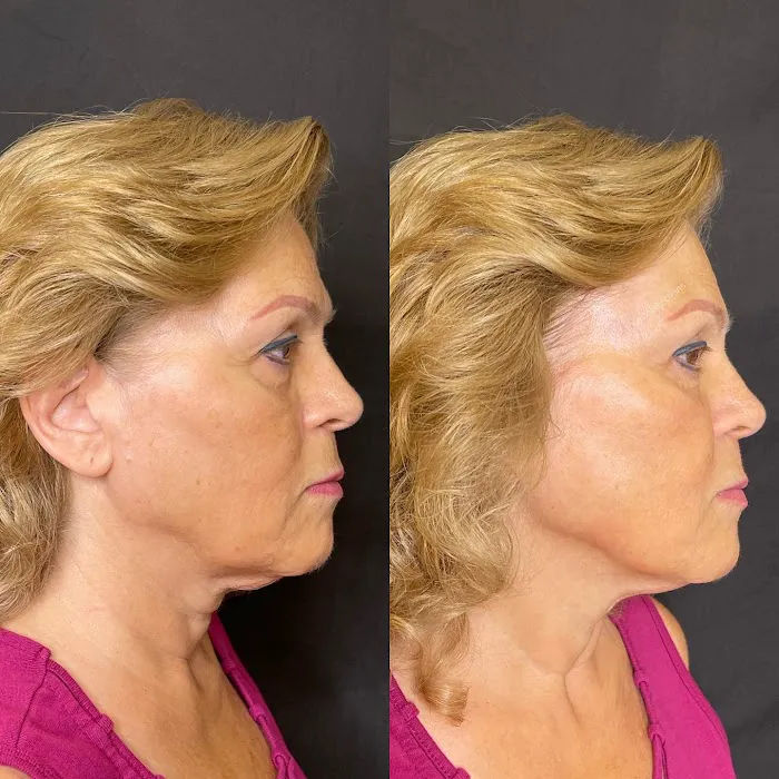 theartofinjections Picture 8