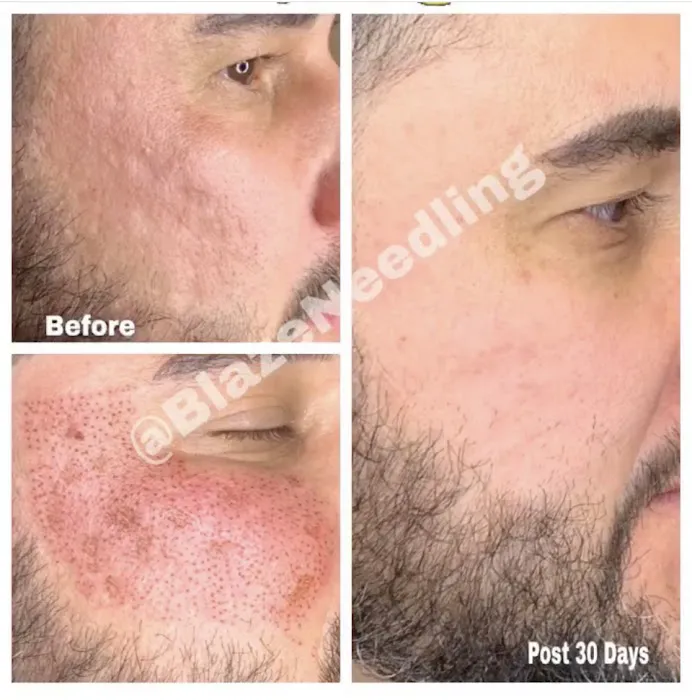 Fibroblast Beverly Hills Picture 2