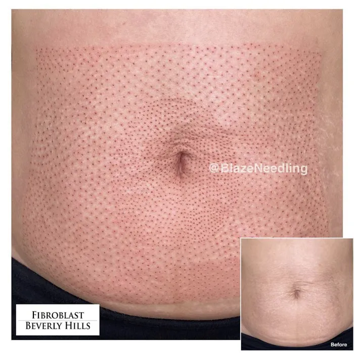 Fibroblast Beverly Hills Picture 6