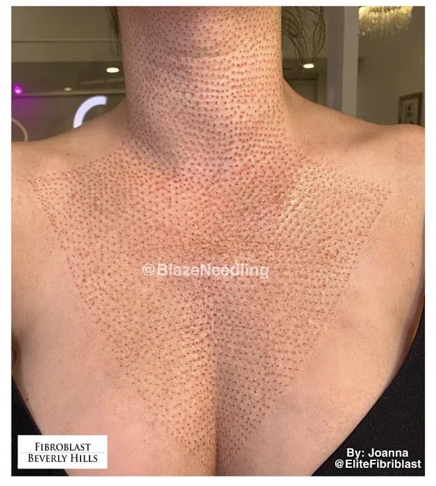 Fibroblast Beverly Hills Picture 5