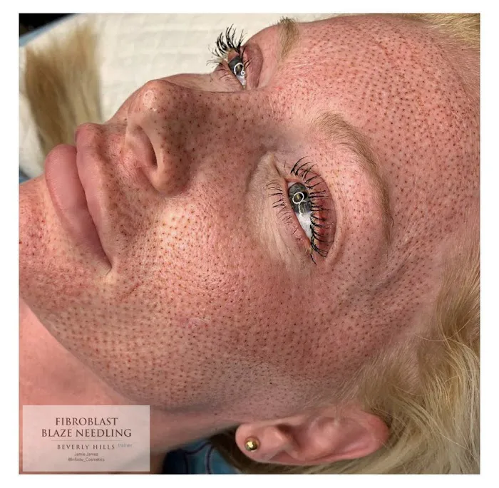 Fibroblast Beverly Hills Picture 4