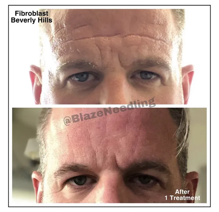 Fibroblast Beverly Hills Picture 9