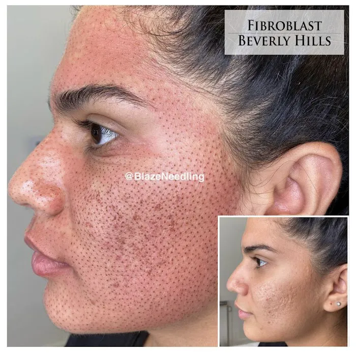 Fibroblast Beverly Hills Picture 10