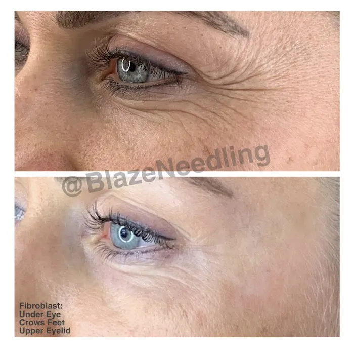 Fibroblast Beverly Hills Picture 8