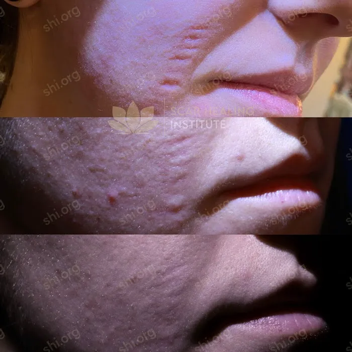 Scar Healing Institute - Best Acne Scar Treatment Center Picture 1