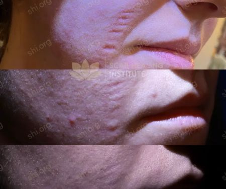 Scar Healing Institute - Best Acne Scar Treatment Center