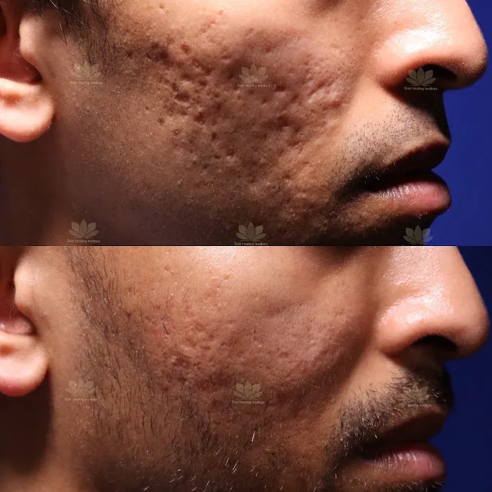 Scar Healing Institute - Best Acne Scar Treatment Center Picture 5