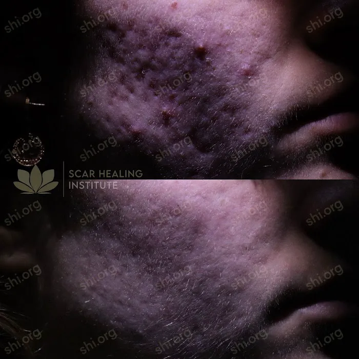 Scar Healing Institute - Best Acne Scar Treatment Center Picture 4