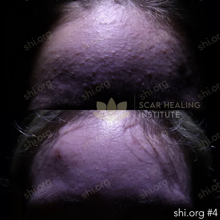 Scar Healing Institute - Best Acne Scar Treatment Center Picture 9
