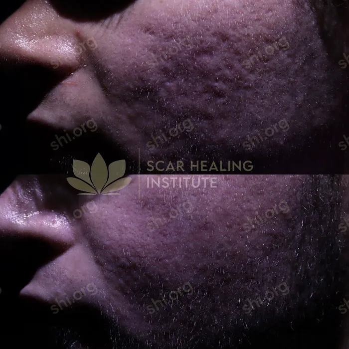 Scar Healing Institute - Best Acne Scar Treatment Center Picture 10