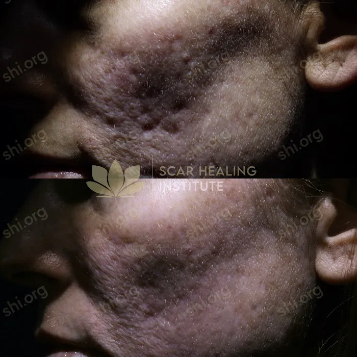 Scar Healing Institute - Best Acne Scar Treatment Center Picture 8