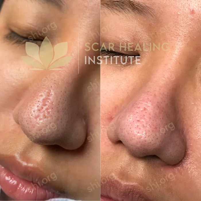 Scar Healing Institute - Best Acne Scar Treatment Center Picture 6