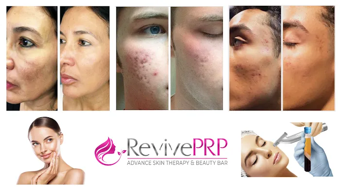 RevivePRP Picture 4