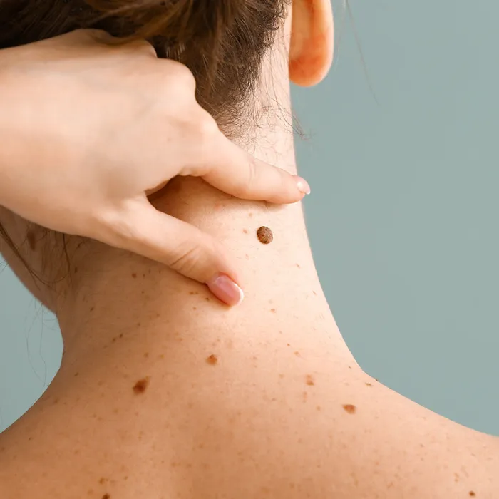 Mole Removal Orange County Picture 6